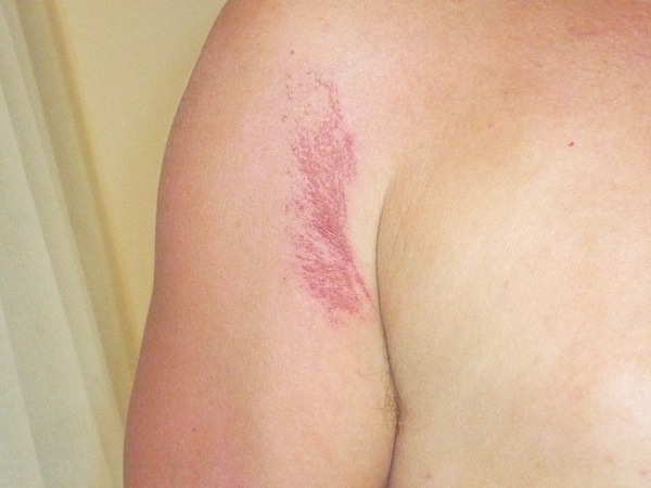 BCD rash.JPG P1040377